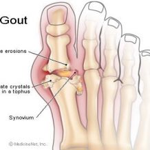 Gout Pain Relief